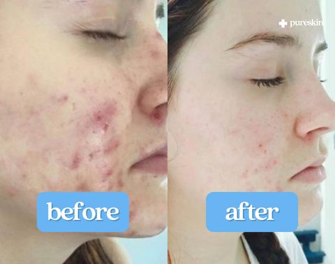 "No more breakouts—I'm hooked!"